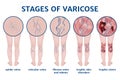 Stages of varicose veins. Disease infographic. Royalty Free Stock Photo